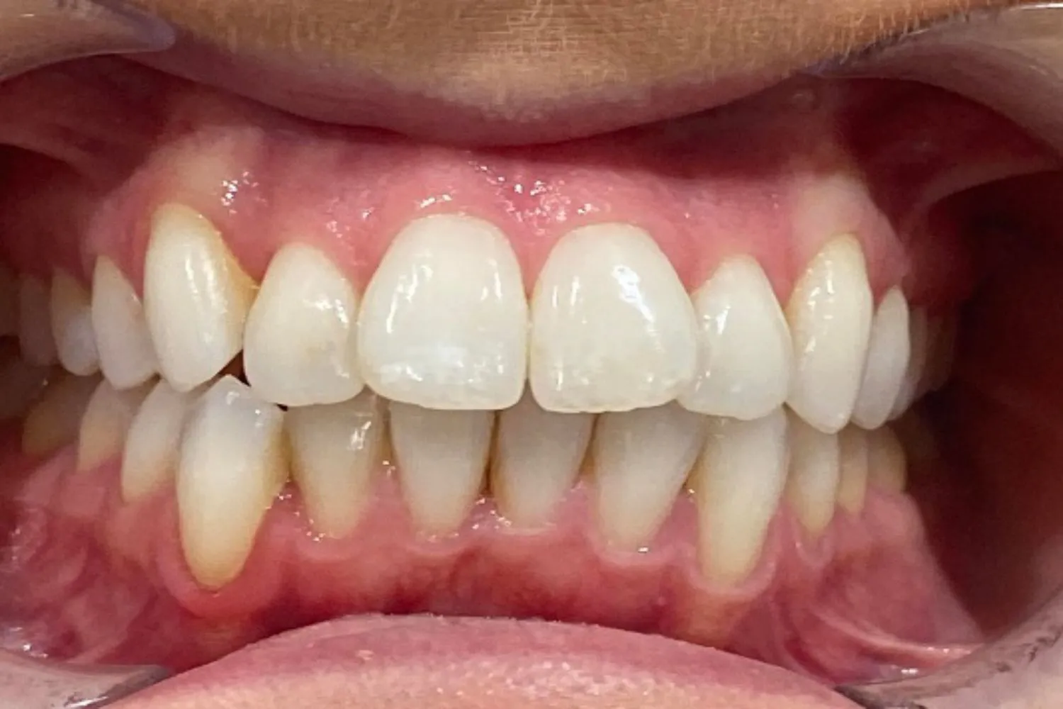 Patient overbite before Invisalign treatment at Maida Smiles