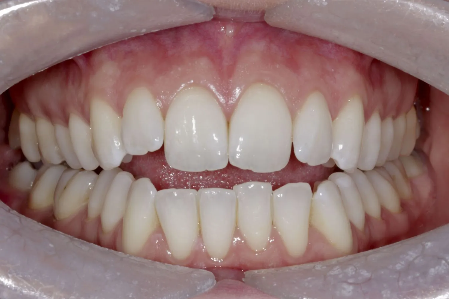 Patient with crooked teeth before Invisalign at Maida Smiles