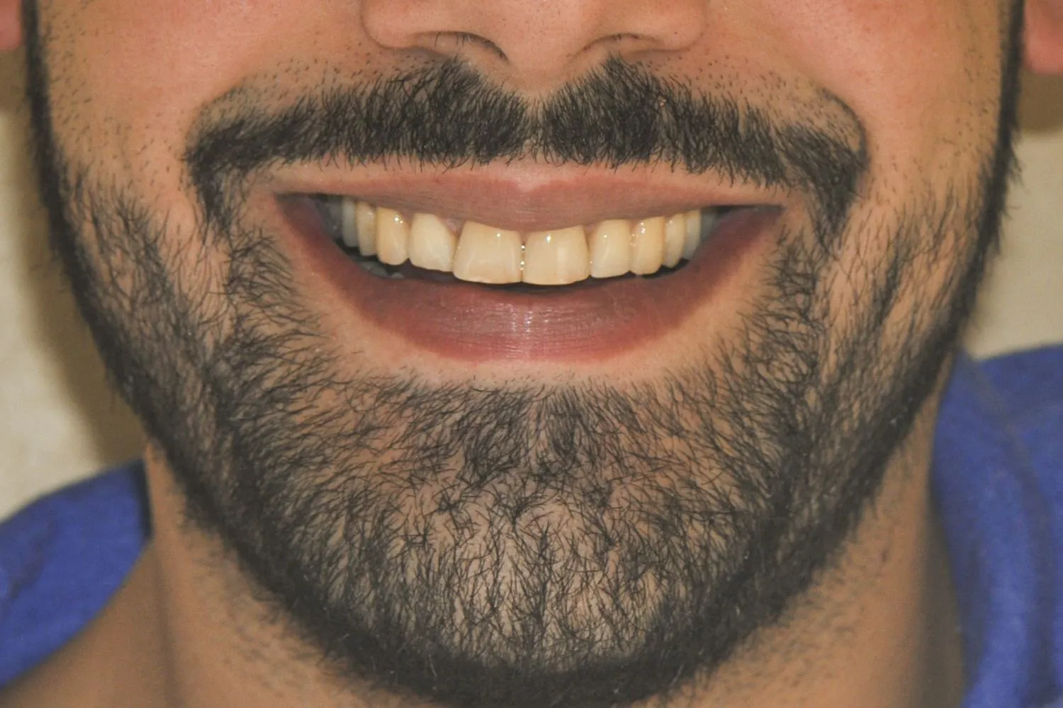 Patient smile after Invisalign teeth straightening at Maida Smiles