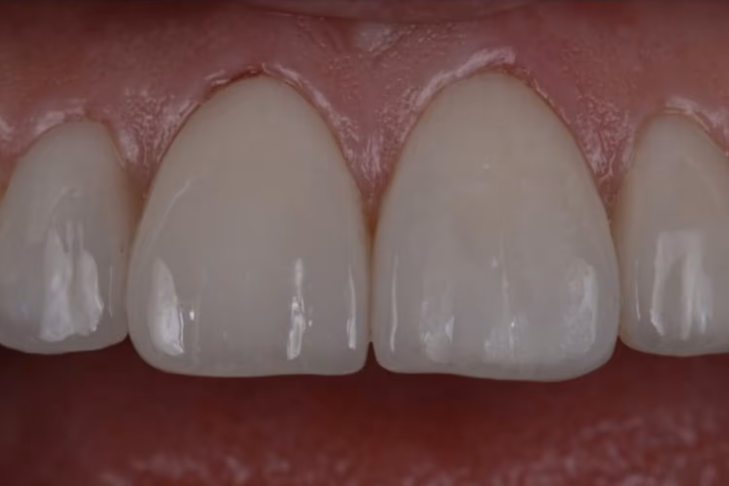 Patient smile after dental veneers at Maida Smiles, Maida Vale