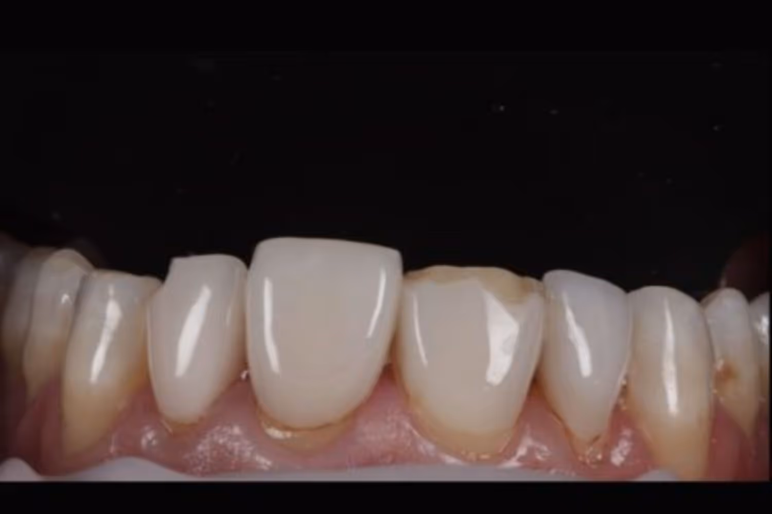 Patient teeth before composite veneers at Maida Smiles