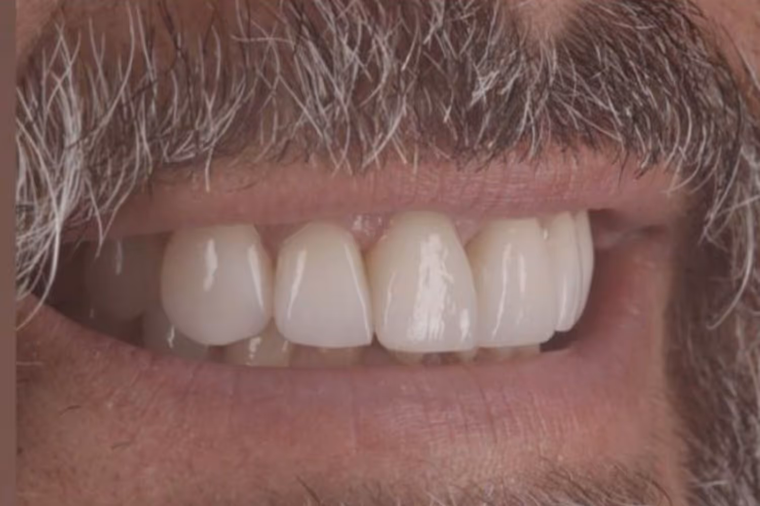 Patient smile after dental veneers at Maida Smiles, Maida Vale