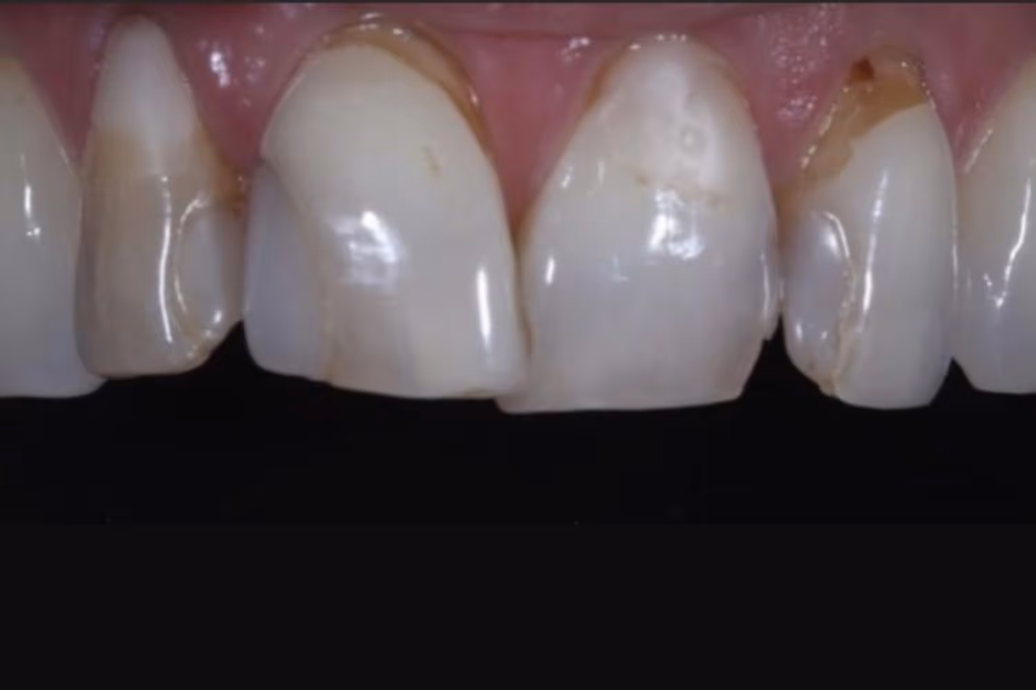 Patient teeth before porcelain veneers at Maida Smiles