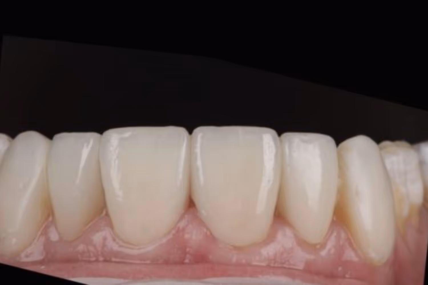 Patient smile after composite veneers at Maida Smiles, Maida Vale