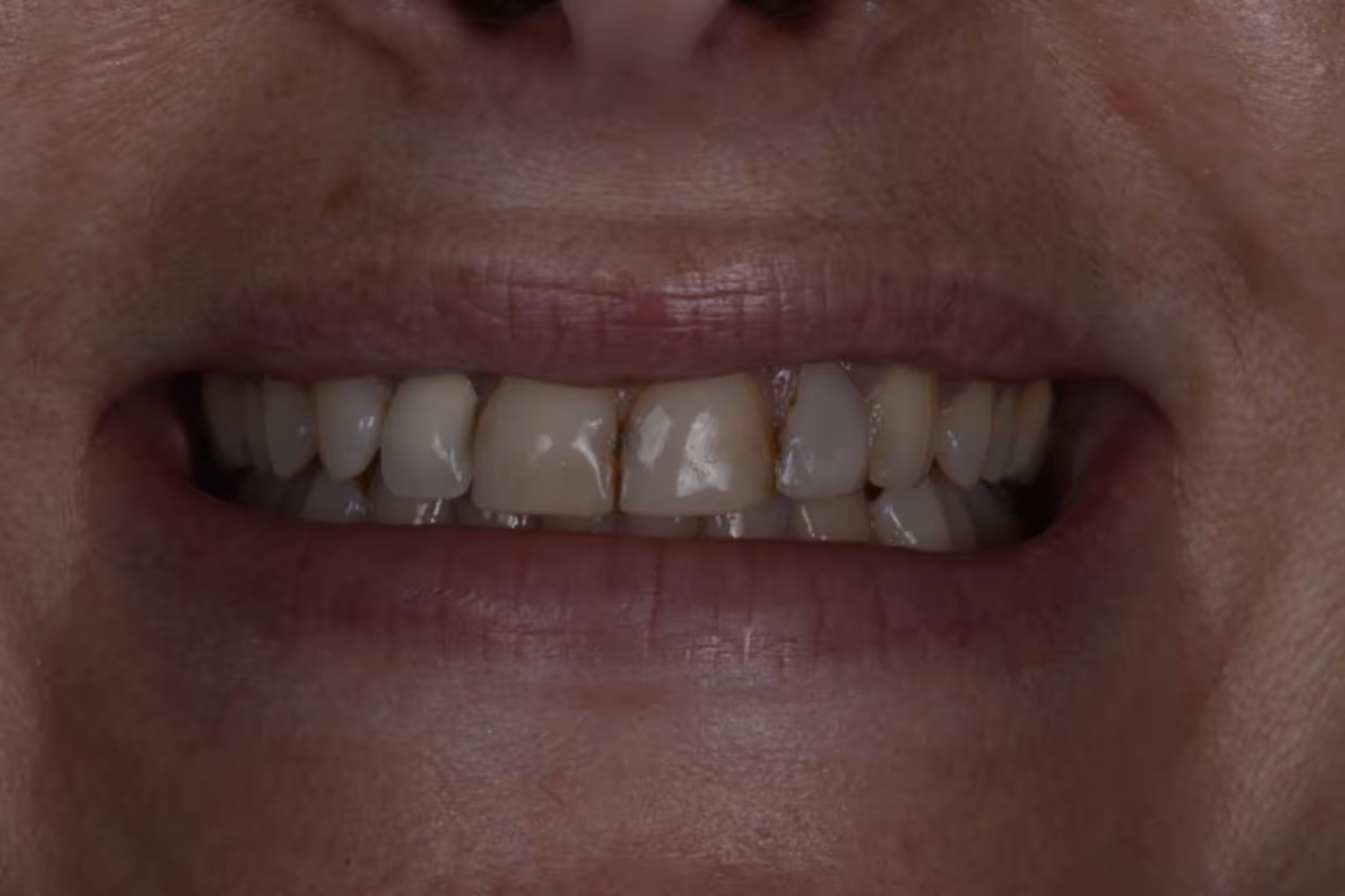 Patient teeth before dental veneers at Maida Smiles