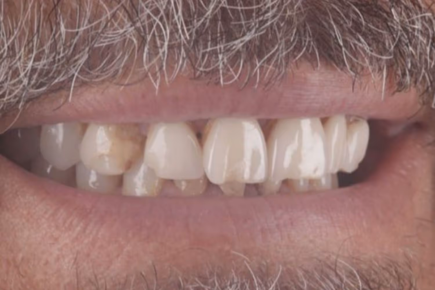 Patient teeth before dental veneers at Maida Smiles