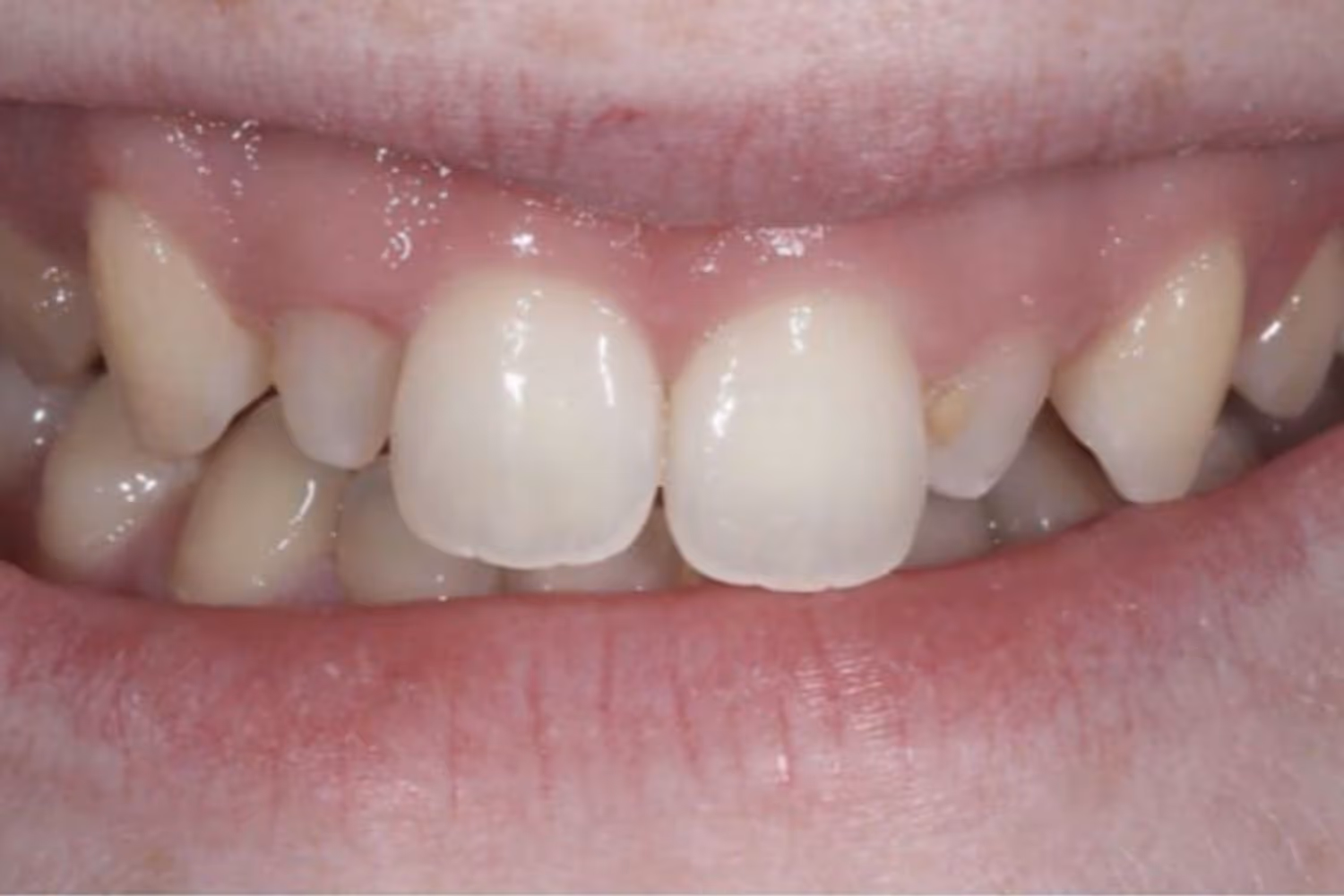 Patient teeth before dental veneers at Maida Smiles