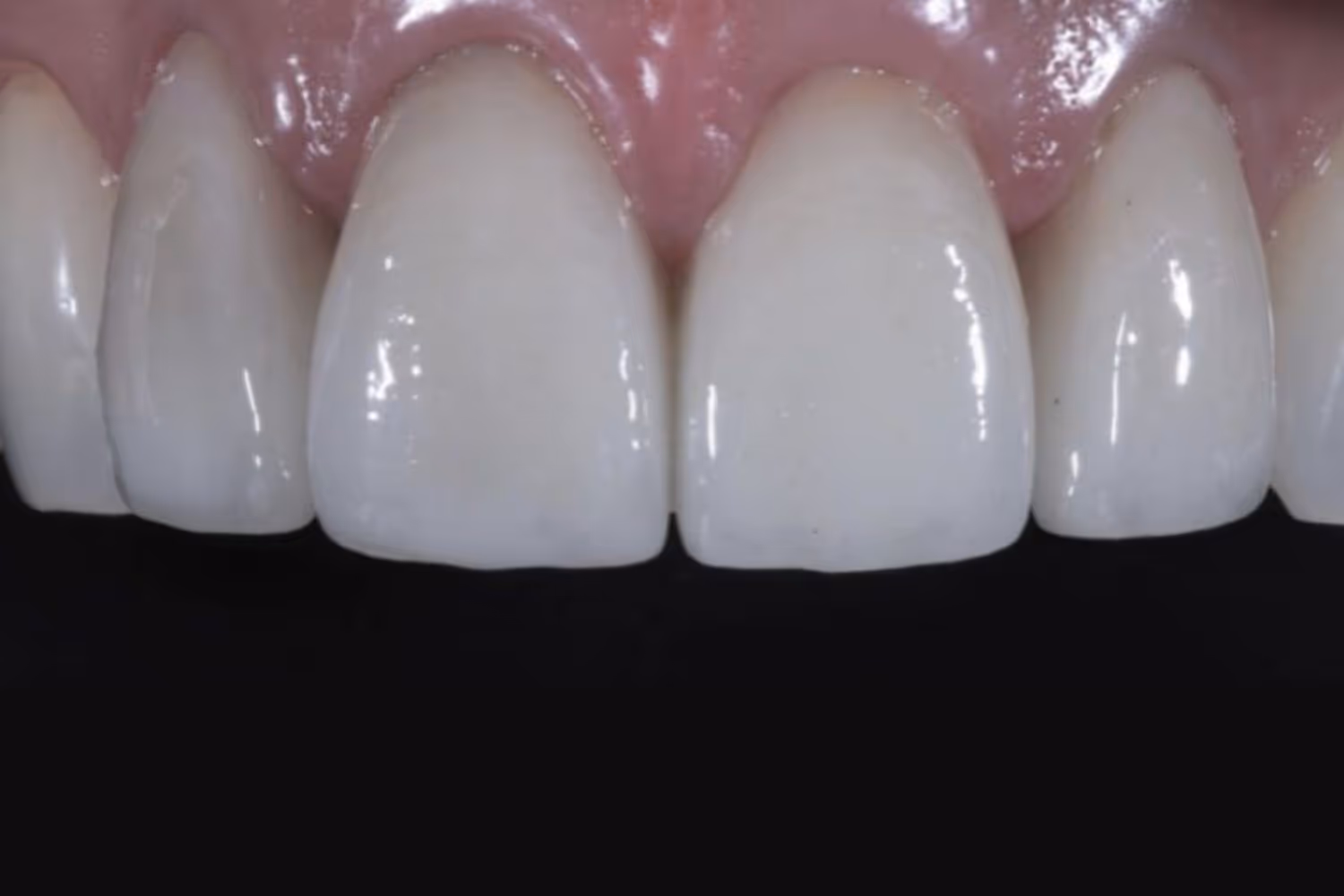 Patient smile after porcelain veneers at Maida Smiles, Maida Vale