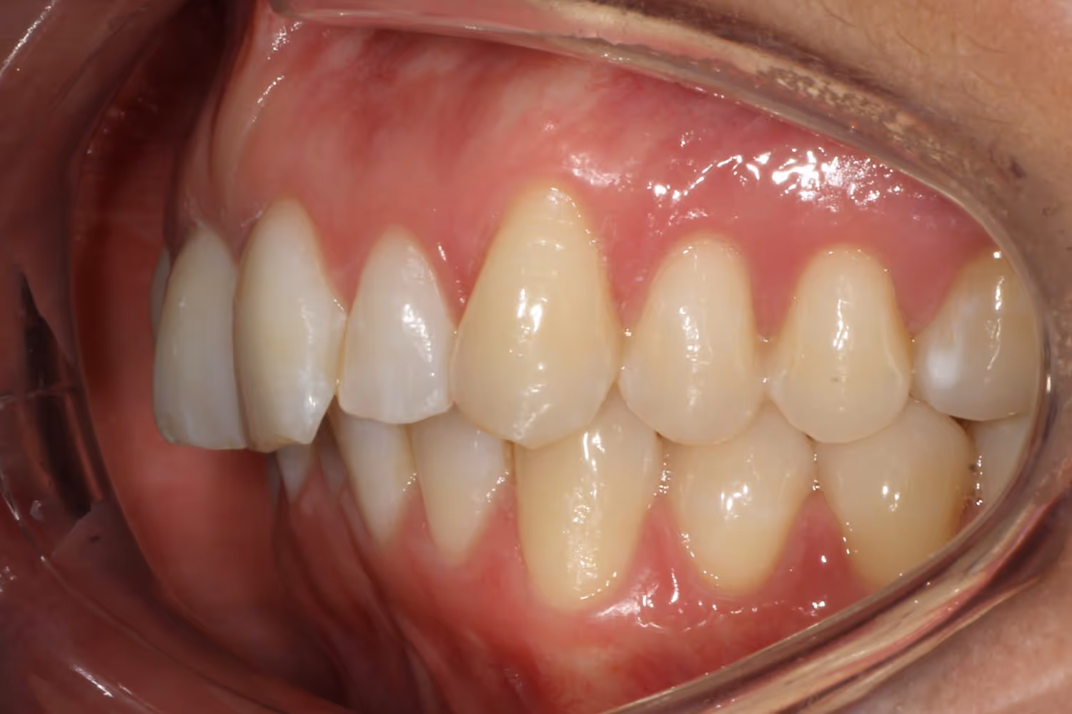 Patient with protruding teeth before Invisalign at Maida Smiles