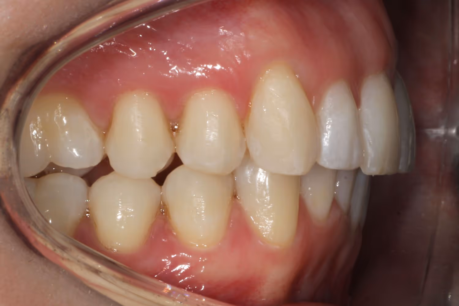 Patient smile after Invisalign teeth straightening at Maida Smiles