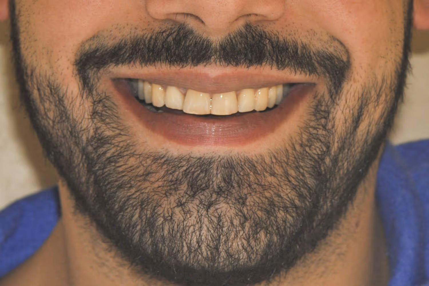 Patient smile after Invisalign teeth straightening at Maida Smiles