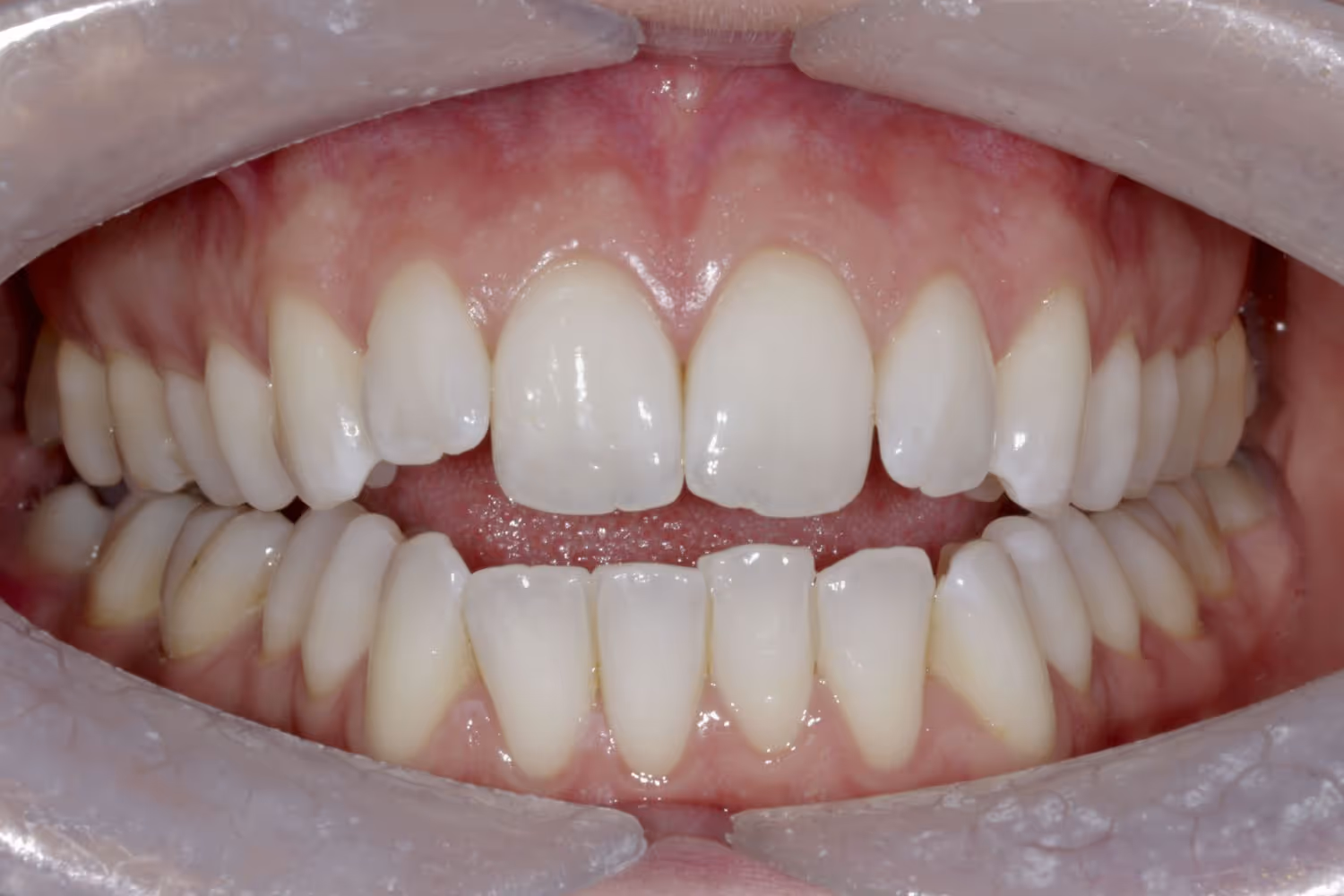 Patient with crooked teeth before Invisalign at Maida Smiles
