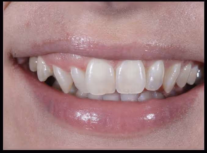Patient with narrow crooked teeth before Invisalign at Maida Smiles