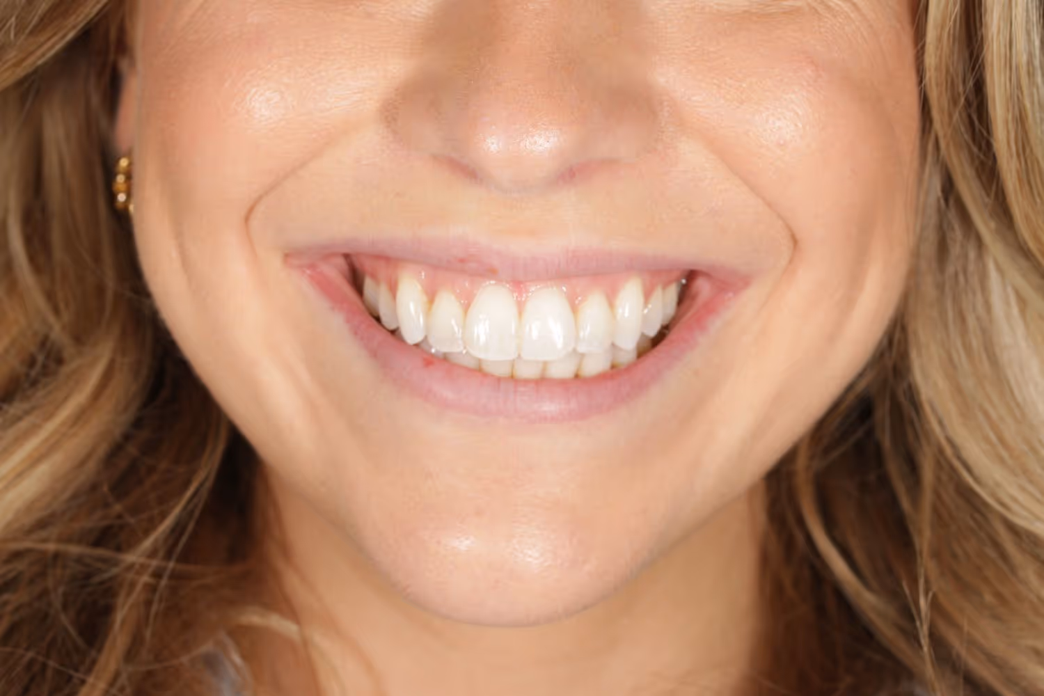Patient smile after Invisalign overbite correction at Maida Smiles