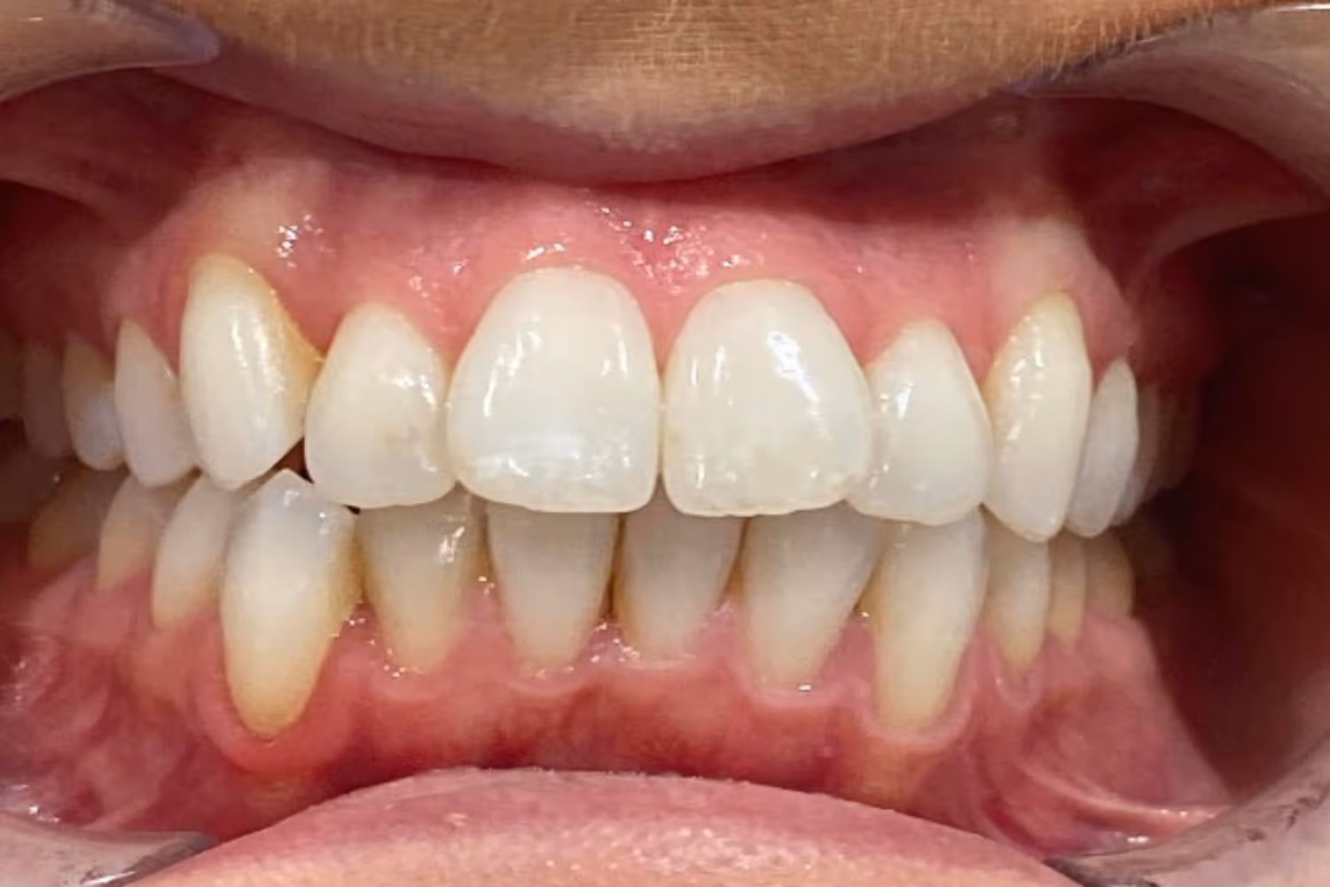 Patient overbite before Invisalign treatment at Maida Smiles