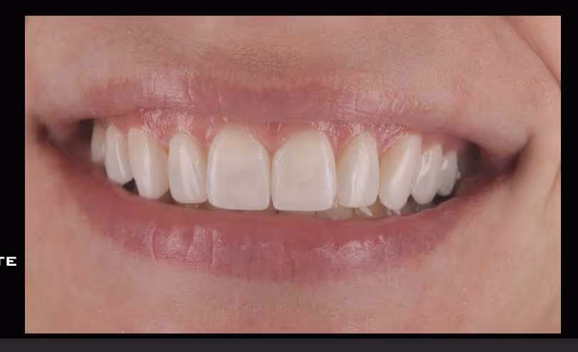 Patient smile after Invisalign and composite bonding at Maida Smiles