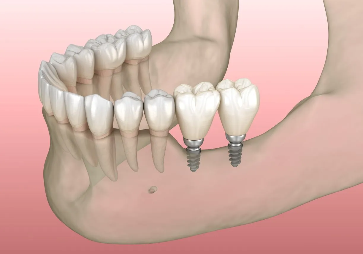 Dental implant treatment slide at Maida Smiles dental clinic, Maida Vale, London