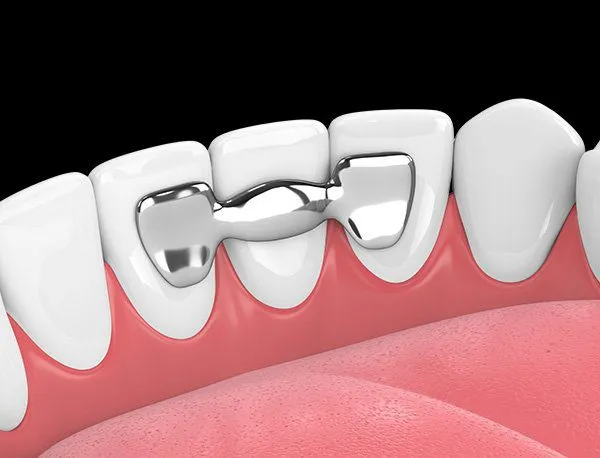 Cover image for the blog post "Maryland Bridge Dental: 5 Key Facts Before You Decide (2026)" — Maida Smiles dental clinic, Maida Vale, London