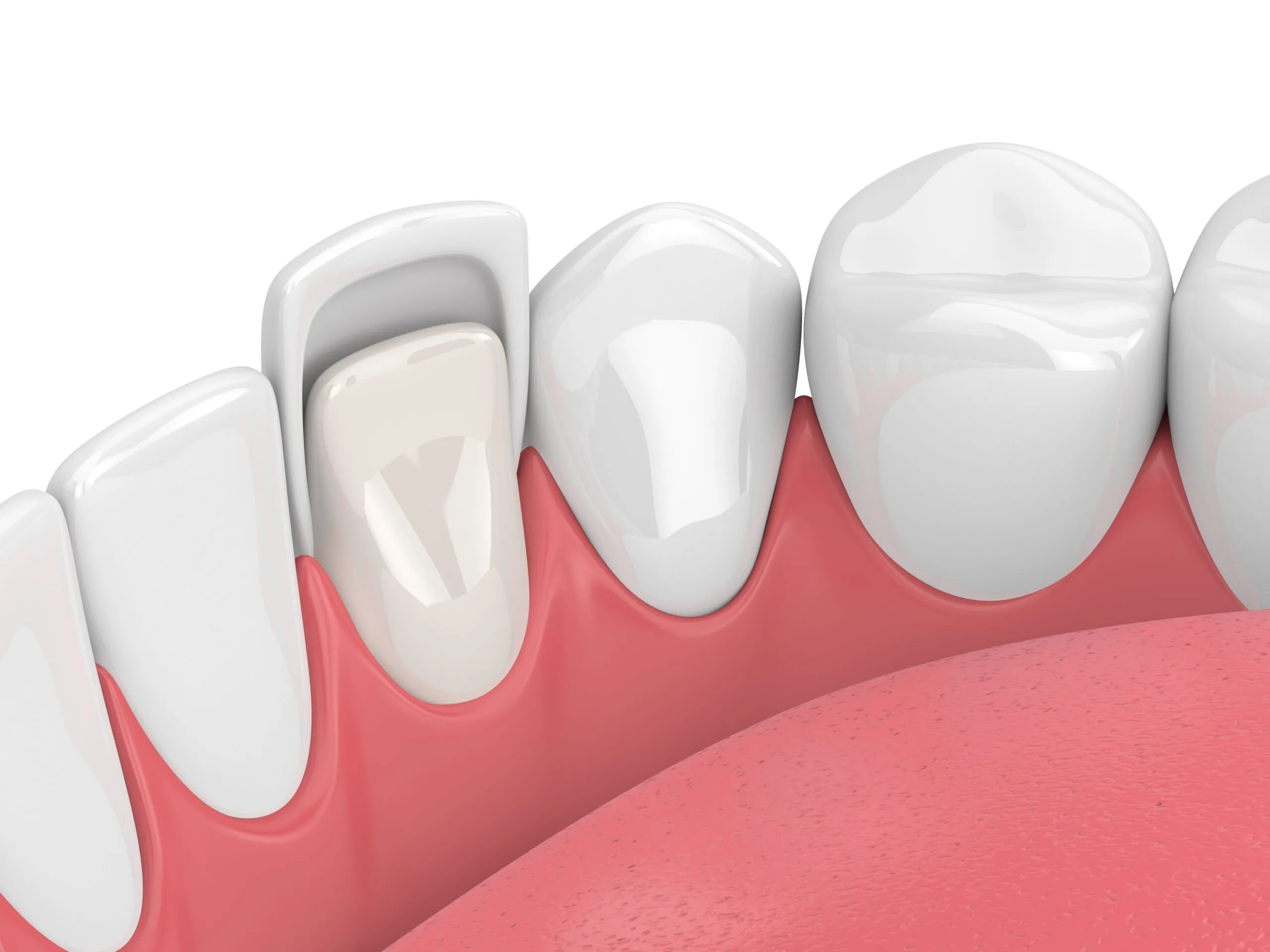 How can veneers help crooked teeth?