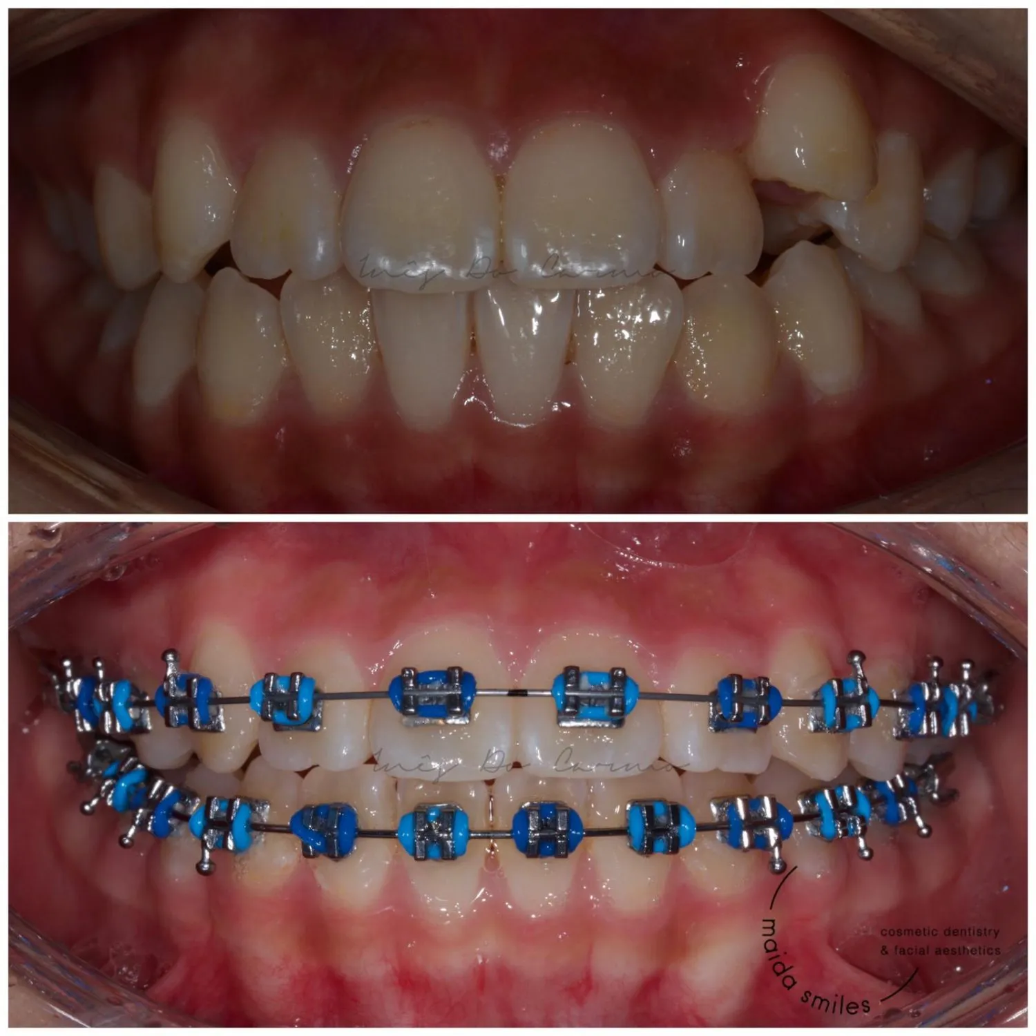 Before and after photos of teeth showing crowding corrected with blue fixed braces