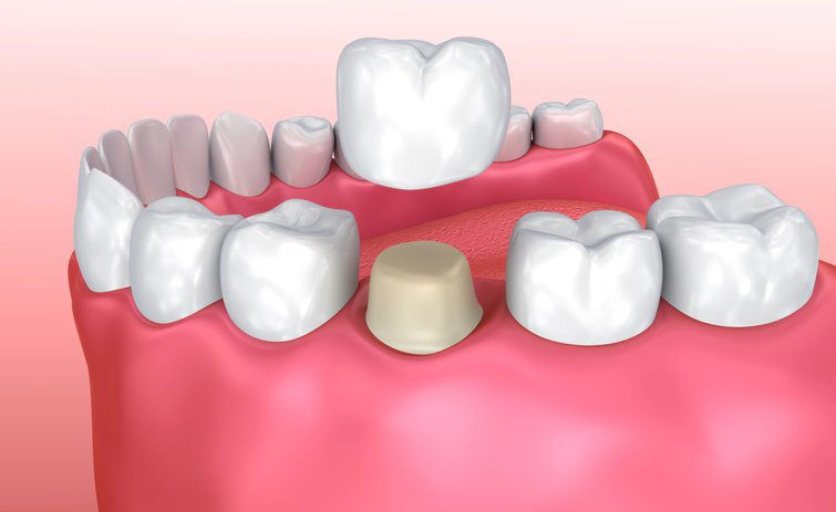 3D render of a dental crown used to restore a tooth after extraction