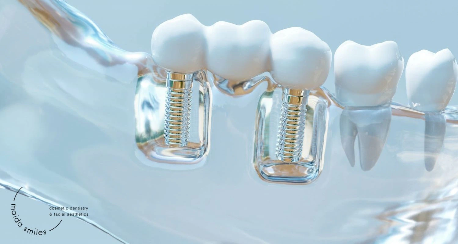 Example dental treatment image at Maida Smiles