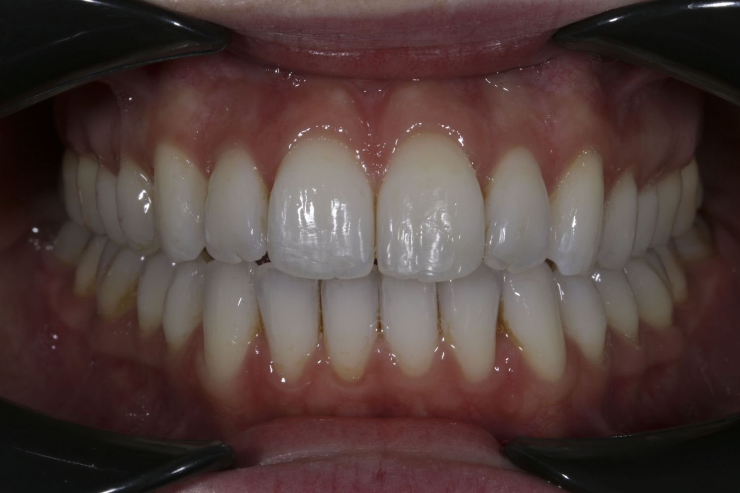 Sonrisa del paciente después de la ortodoncia con Invisalign en Maida Smiles