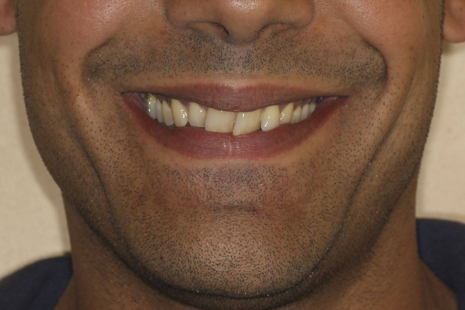 Dientes del paciente antes de Invisalign en Maida Smiles