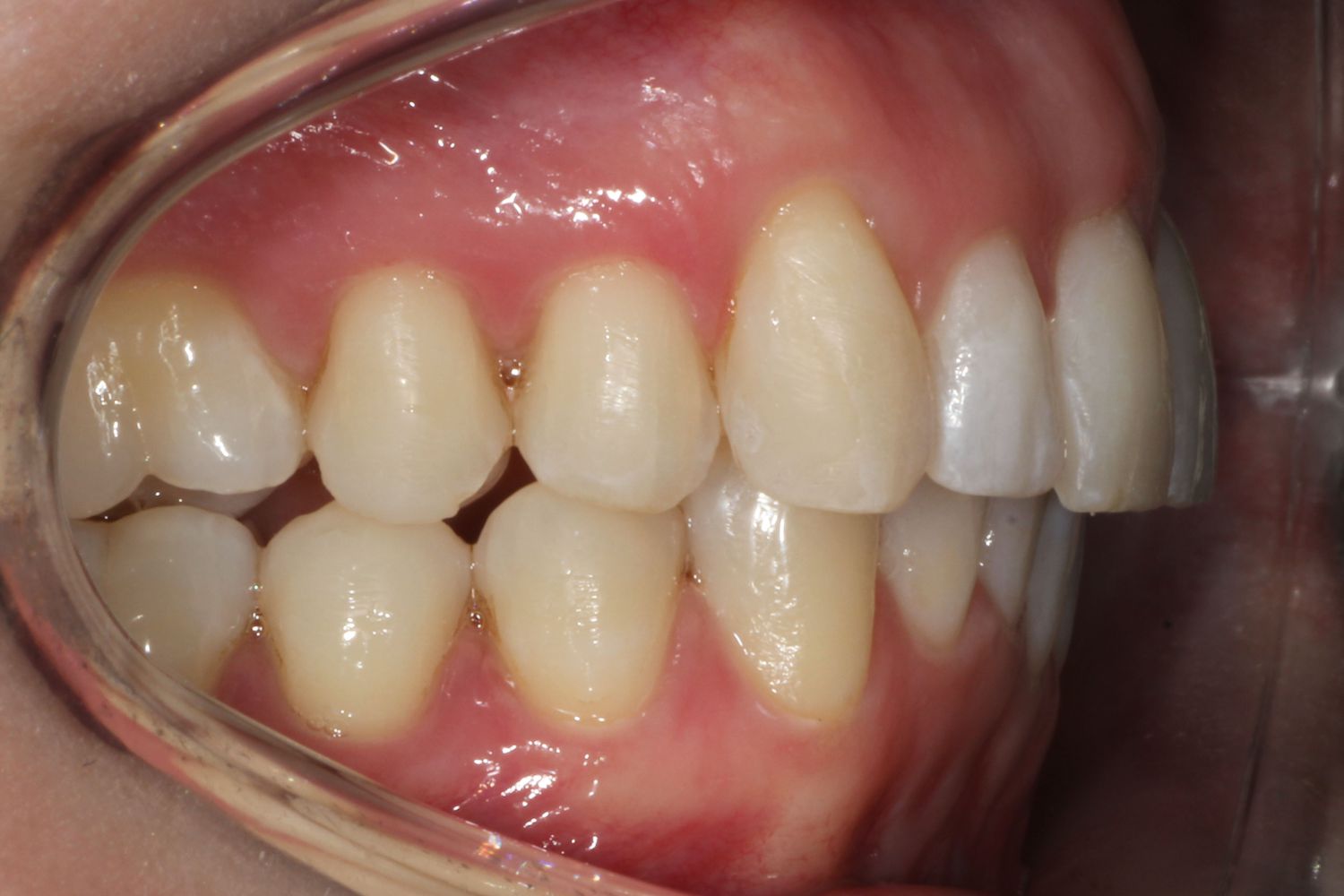 Sonrisa del paciente después de la ortodoncia con Invisalign en Maida Smiles