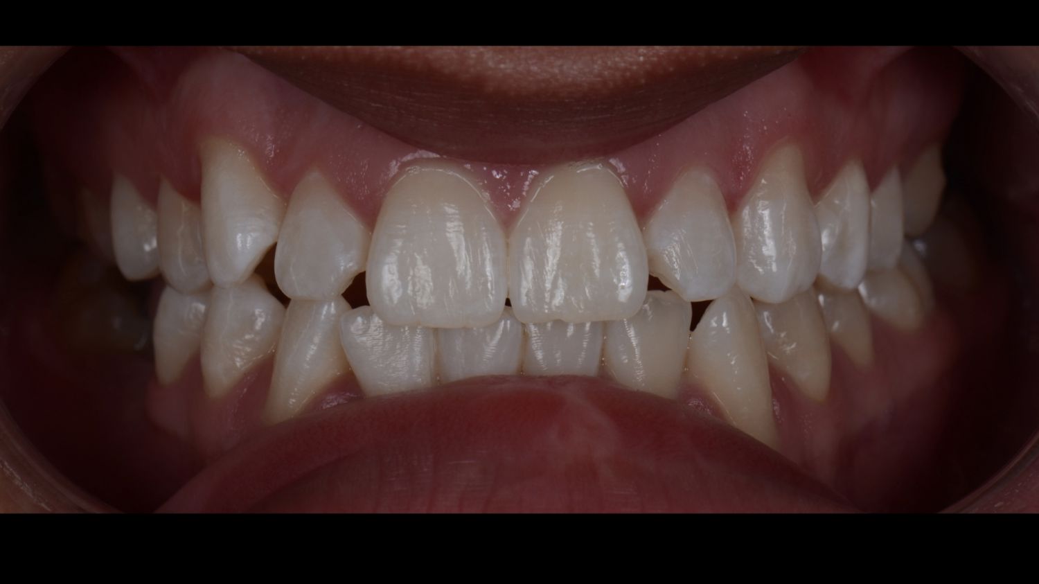 Sorriso do paciente depois do branqueamento dentário na Maida Smiles, Maida Vale