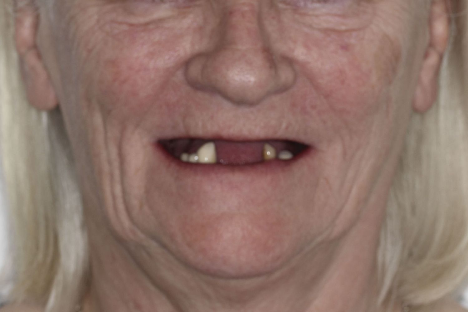Paciente com dentes em falta antes do tratamento com implantes dentários na Maida Smiles