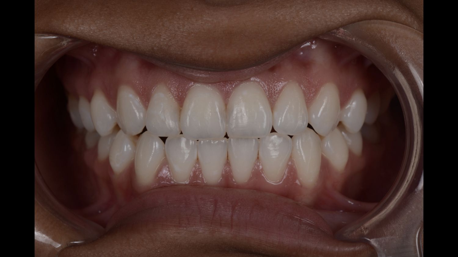 Sorriso do paciente depois do branqueamento dentário na Maida Smiles, Maida Vale