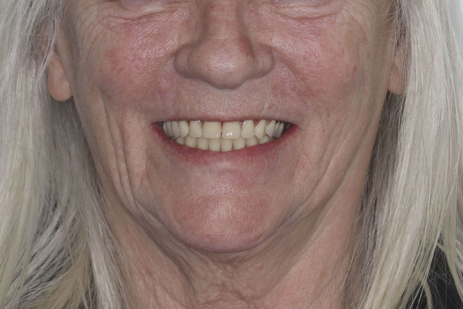 Sorriso do paciente depois dos implantes dentários na Maida Smiles, Maida Vale