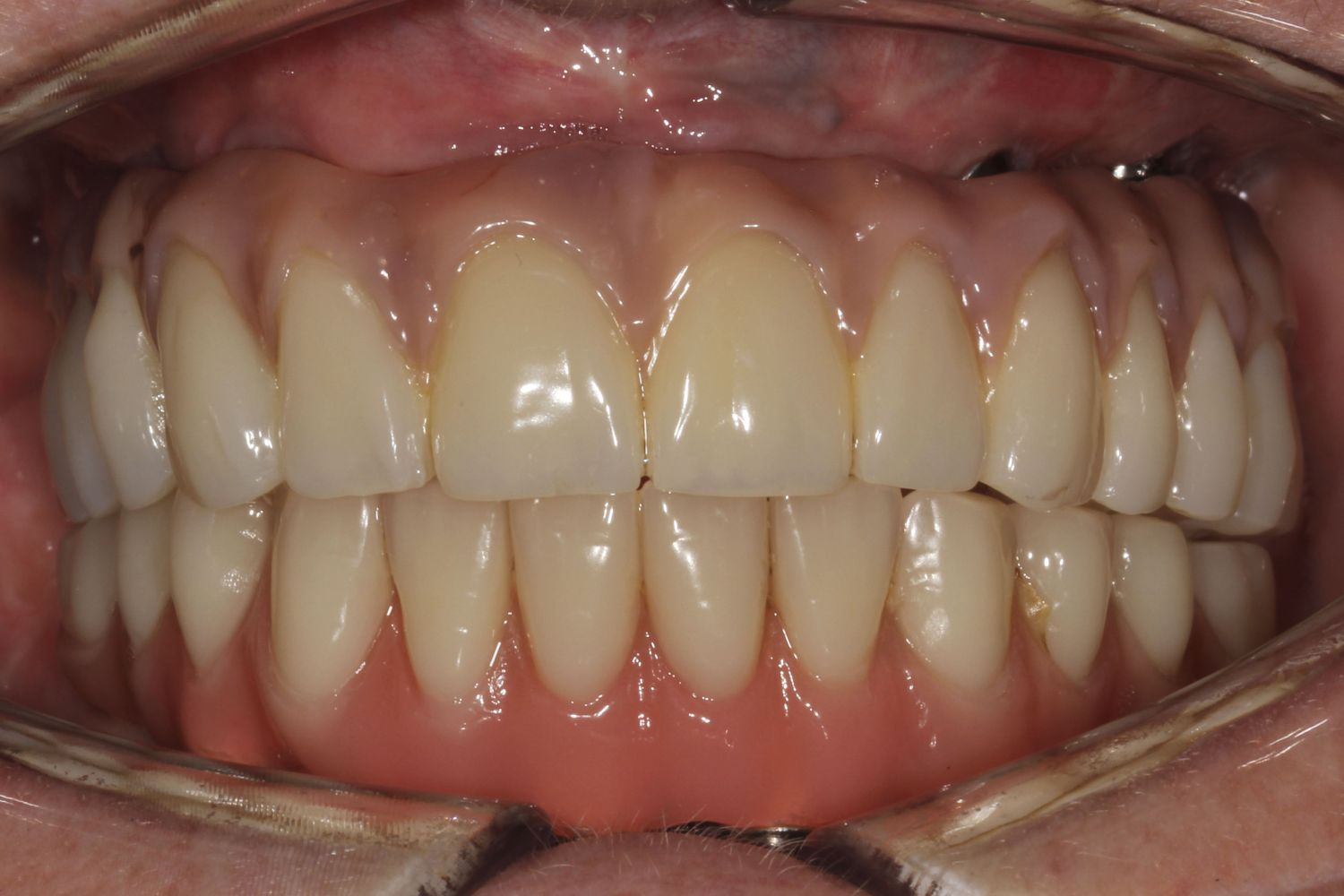 Sorriso do paciente depois dos implantes dentários na Maida Smiles, Maida Vale