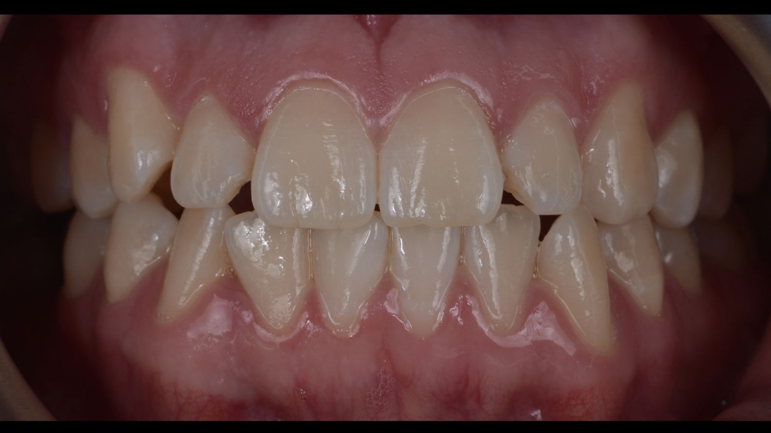 Dentes do paciente antes do branqueamento dentário na Maida Smiles