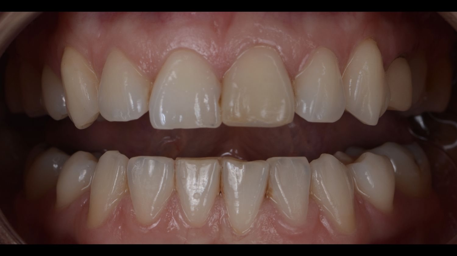 Dente do paciente antes da coroa dentária na Maida Smiles