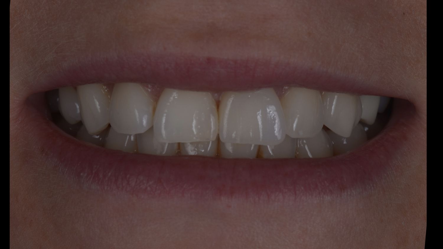 Sorriso do paciente depois da coroa dentária na Maida Smiles, Maida Vale
