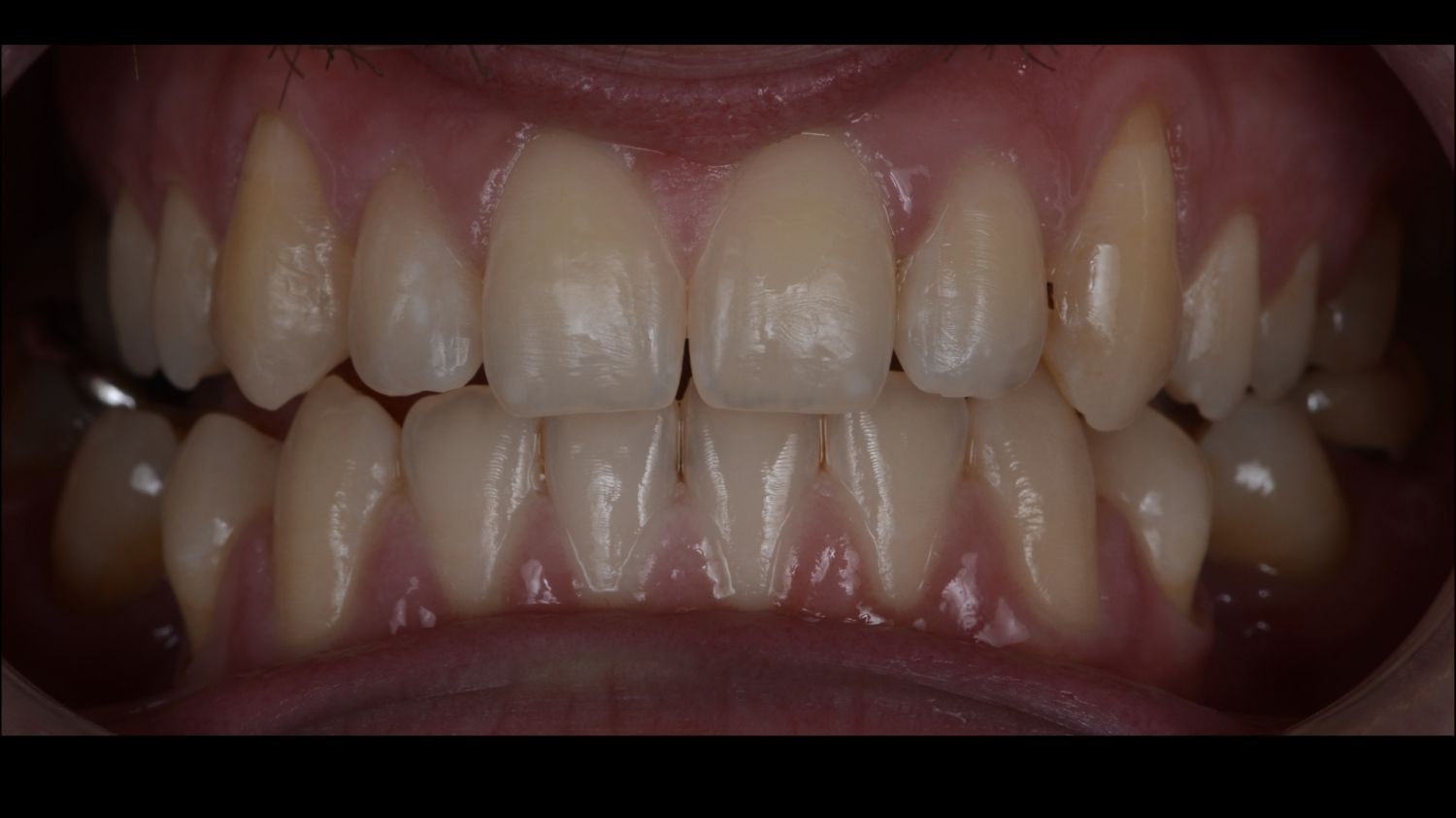 Dentes do paciente antes do branqueamento dentário na Maida Smiles