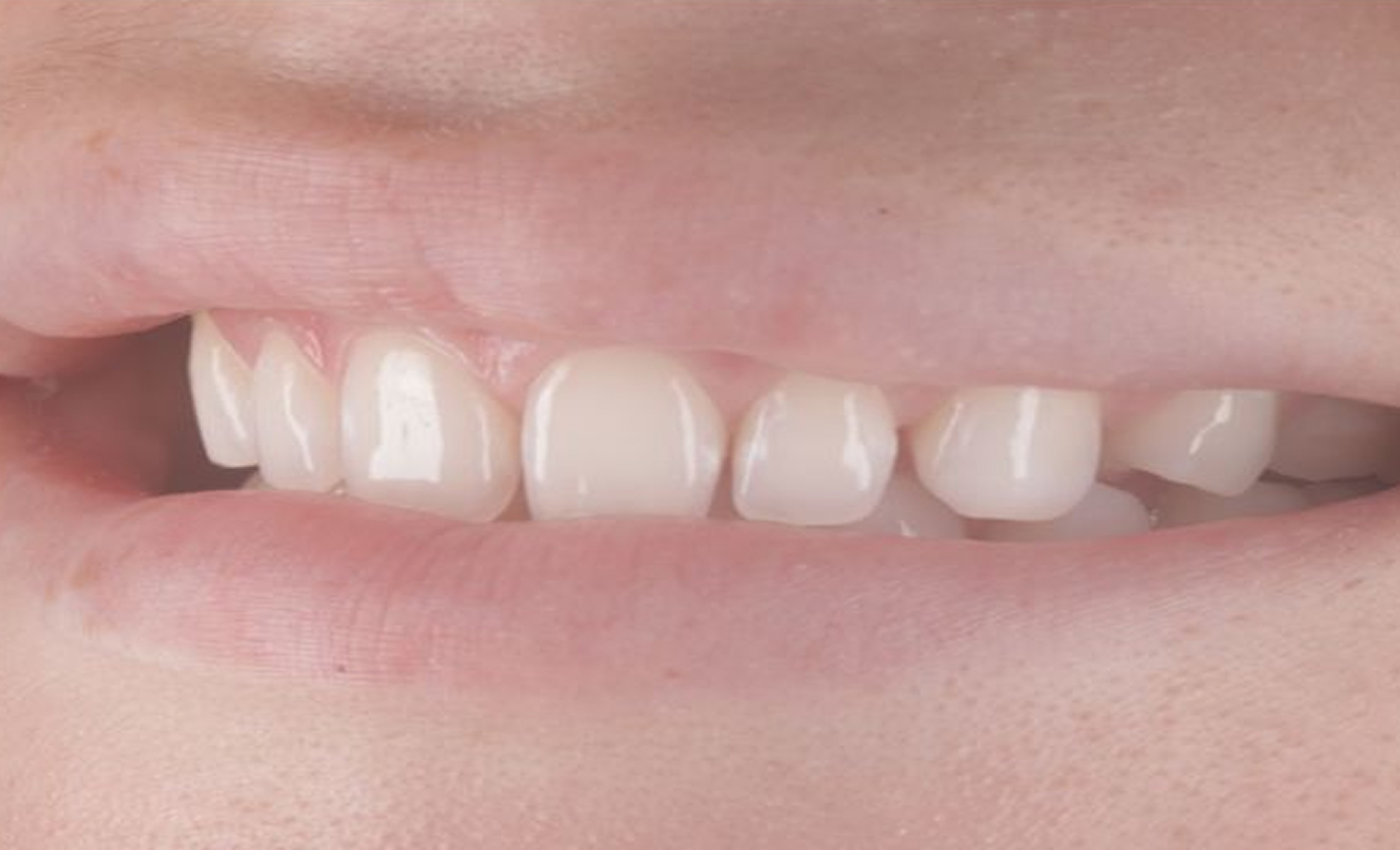 Dentes do paciente antes do bonding de compósito na Maida Smiles