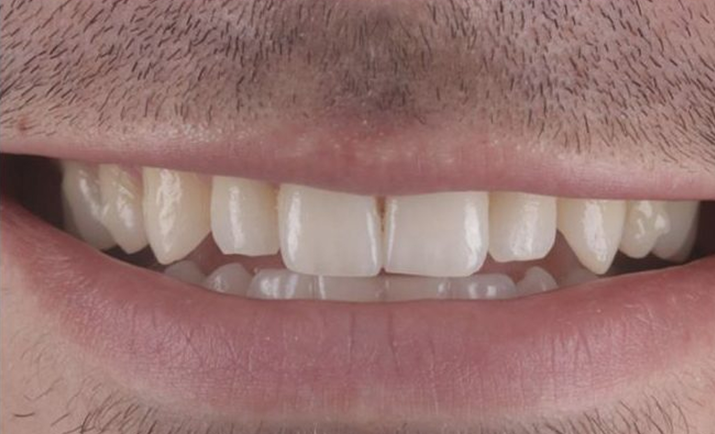 Dentes do paciente antes do bonding de compósito na Maida Smiles
