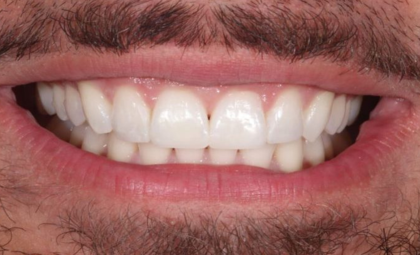 Sorriso do paciente depois do bonding de compósito na Maida Smiles, Maida Vale