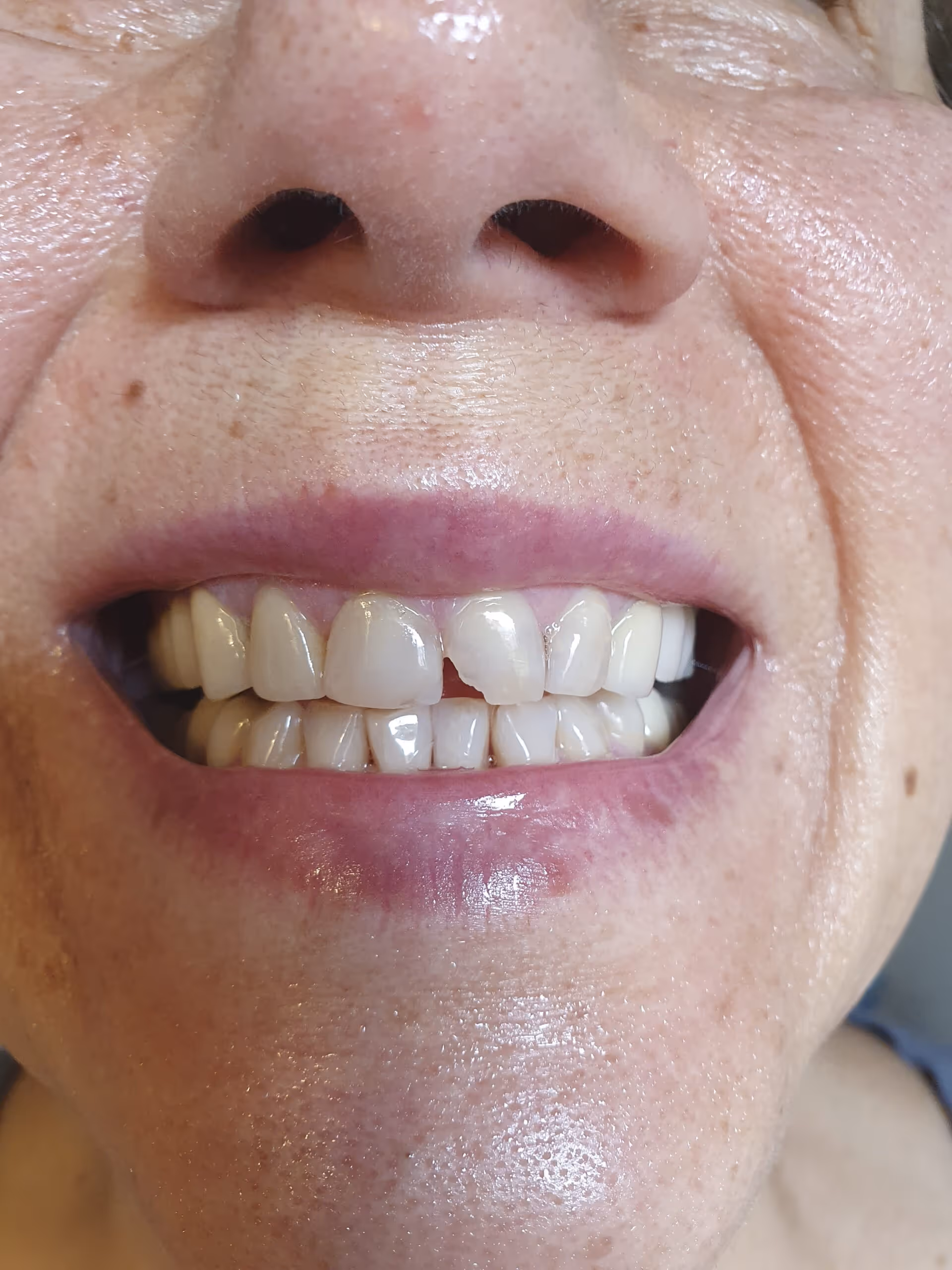 Imagem de capa do artigo «Dente Partido - O seu guia passo a passo» — clínica dentária Maida Smiles, Maida Vale, Londres