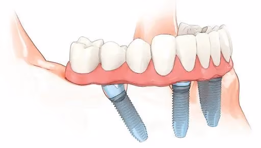 Los cinco pasos del implante dental