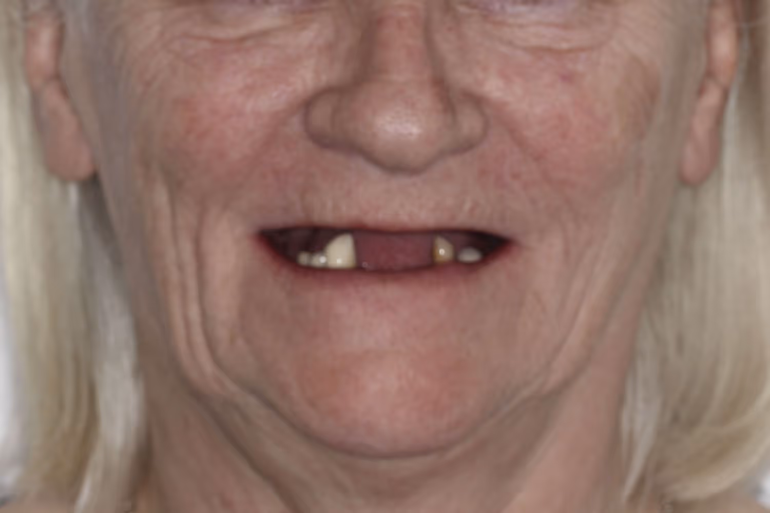 Imagem de capa do artigo «Os implantes dentários estão disponíveis através do SNS?» — clínica dentária Maida Smiles, Maida Vale, Londres