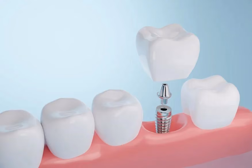 Imagen de portada del artículo «¿Cuánto tiempo deberían durar los implantes dentales?» — clínica dental Maida Smiles, Maida Vale, Londres