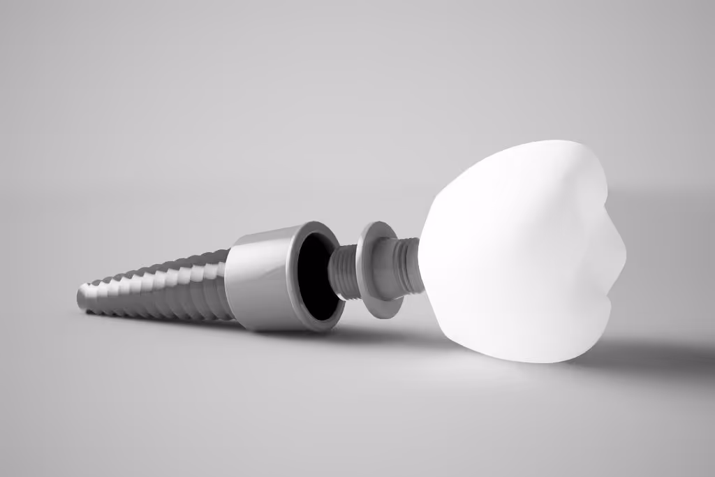 Imagen de portada del artículo «¿Qué tan fuertes son realmente los implantes dentales?» — clínica dental Maida Smiles, Maida Vale, Londres