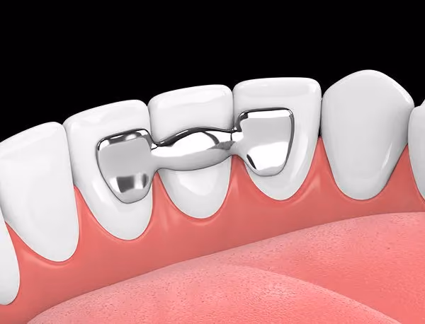 Imagem de capa do artigo «Ponte Dentária de Maryland: 5 Factos Essenciais Antes de Decidir (2026)» — clínica dentária Maida Smiles, Maida Vale, Londres