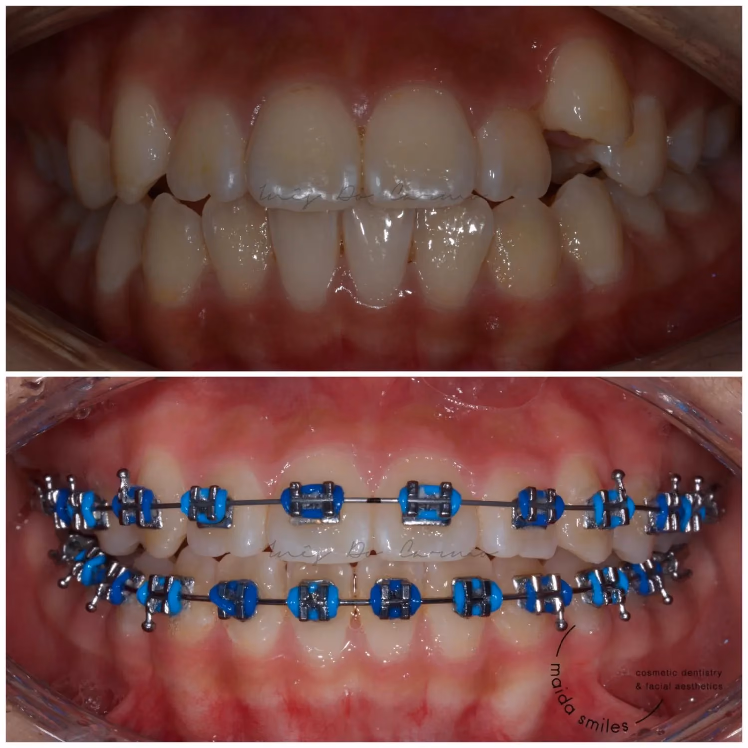 Brackets metálicos fijos: atención al paciente en Maida Smiles, Londres