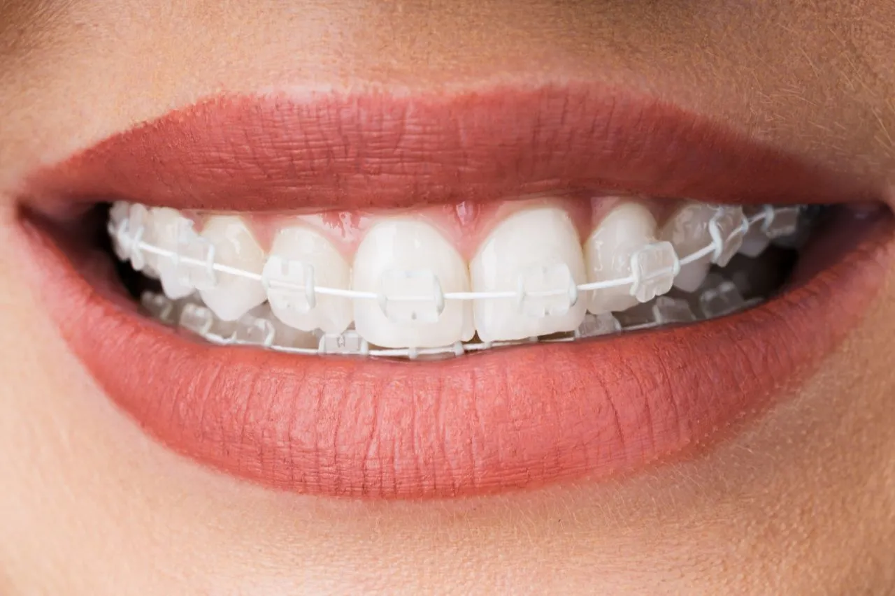Brackets de cerámica: atención al paciente en Maida Smiles, Londres