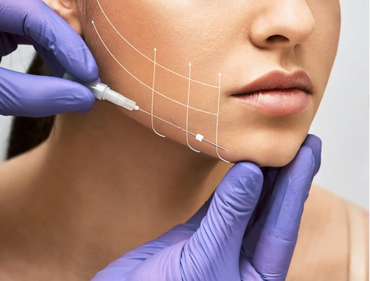 Thread Lift